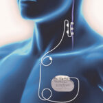 VNS Therapy: Understanding its Benefits and Process